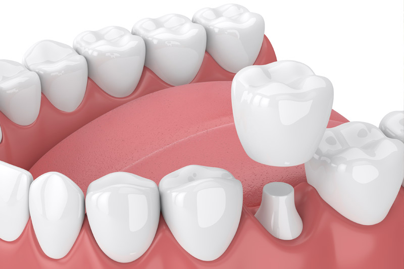 Dental Crowns in Covington