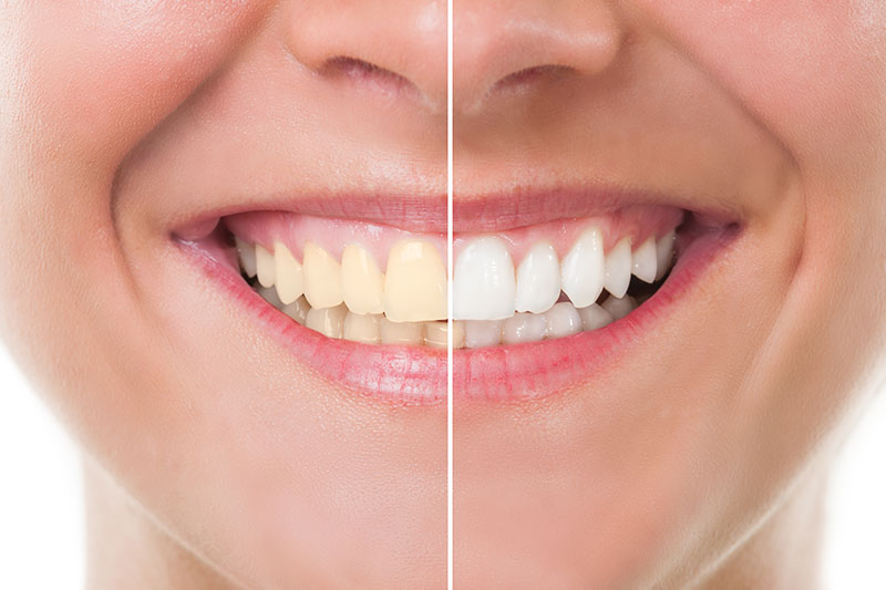 Teeth Whitening in Covington