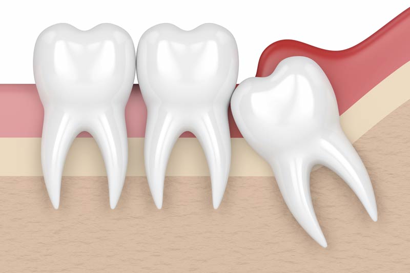 Wisdom Tooth Removal in Covington